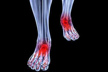 Arthritic foot care in the Palm Beach County, FL: West Palm Beach (Royal Palm Beach, Loxahatchee, Riviera Beach, Boca Del Mar, Belle Glade)